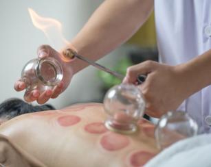 Image of a person receiving a cupping treatment on their back.
